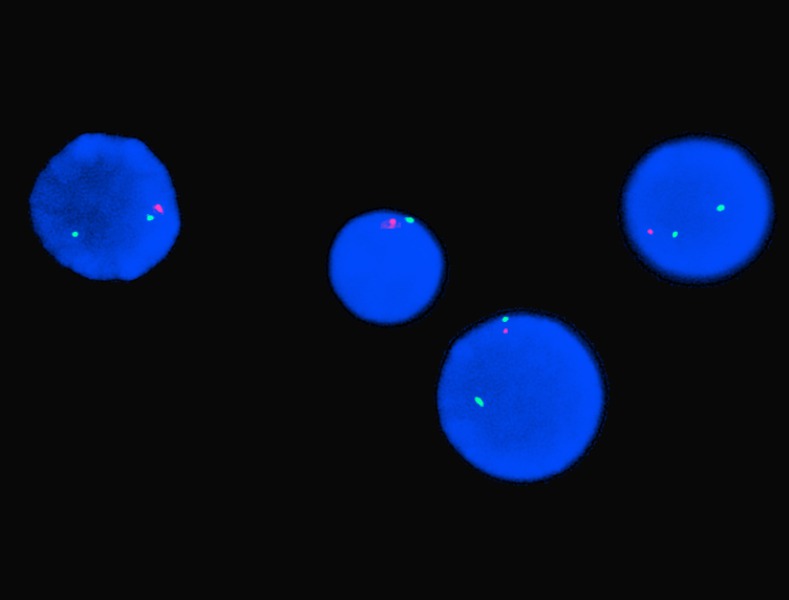 FISH probe analysis at initial diagnosis demonstrating the presence of only one chromosome #7 signal (red); karyotype analysis revealed monosomy #7.